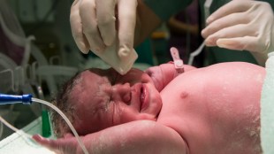 Anterior polar cataract in infants, cataract in infants causes, cataract surgery in infants, congenital cataract surgery in infants, can babies with cataracts see, can babies have cataracts, what causes cataracts in babies, what causes cataracts in newborns, cataract in a child, cataract congenital aao, cataract in a baby, what are baby cataracts, cataracts in a newborn, cataract child blindness, cataract in babies eyes, bilateral cataracts in babies, bilateral cataracts in newborn, baby cataracts in adults, cataract in baby causes, bilateral congenital cataracts in babies, cataract congenital causes, can newborns have cataracts, causes of cataract in infants, congenital cataract in child, congenital cataract in babies, congenital cataract in newborn, infant cataract, infant cataract surgery, cataract congenital eyewiki, cataract surgery infants, gestational cataracts, cataracts in infants, cataract congenital heart disease, cataract in newborn is, cataract in newborn is zonular, juvenile cataract causes, juvenile cataract age, cataract in newborn causes, neonatal cataract causes, cataract in premature babies, pediatric cataract causes, cataract in congenital rubella syndrome, cataract in child symptoms, cataract in congenital syphilis, cataract in small child, bilateral cataract in congenital syphilis, cataract baby surgery, cataract congenital surgery, what happens if a baby is born with cataracts, cataract in child treatment, cataract in congenital toxoplasmosis, cataract newborn treatment, cataract congenital types, infantile cataract definition, cataract in toddler, unilateral cataract in newborn, what causes cataracts in infants, what causes cataract in babies, cataract in young child, cataract in 1 year old, cataract in 2 year old, baby cataracts symptoms, baby cataracts treatment, infant cataract surgery outcomes, 2 cataracts in one eye, 3 cataracts in one eye, cataract in 5 year old, cataract in 6 year old, health news, wellness news, eye health,