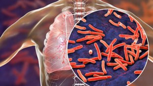 AI-led solutions help screening for the disease.