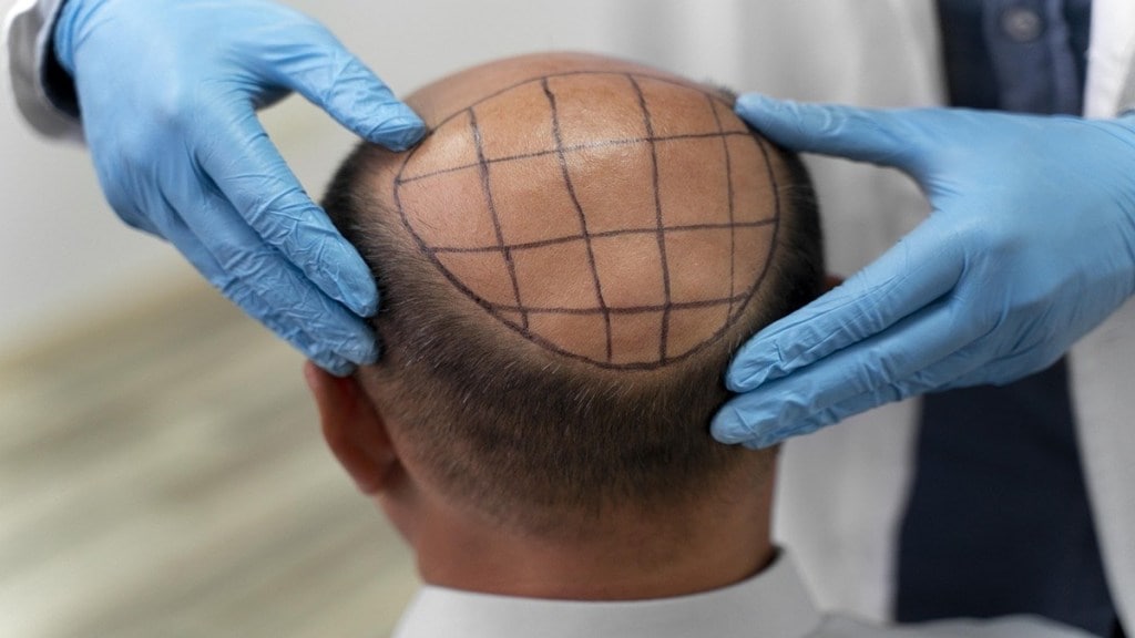 hereditary baldness, hereditary baldness symptoms, hereditary baldness treatment, androgenic alopecia, androgenic alopecia symptoms, androgenic alopecia news, health news, wellness news,