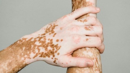 autoimmune disease, life, health and wellness