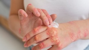 Home remedy for skin allergy itching, best cream for skin allergy, child skin allergy treatment at home, dog skin allergy treatment, itchy skin allergy, list of ointments for skin allergy, skin allergy medicine, skin allergy rash, skin allergy types with pictures, skin allergy app, skin allergy around the eyes, skin allergy at night, skin allergy app free, skin allergy antihistamine, skin allergy after surgery, skin allergy after shaving, skin allergy and itching, skin allergy around mouth, skin allergy atopy in dogs, Allegra 120 for skin allergy, antihistamine for skin allergy, Allegra 180 for skin allergy, Alaspan tablet for skin allergy, antibiotic for skin allergy, ayurvedic medicine for skin allergy, Avil tablet for skin allergy, Allerta for skin allergy, Allegra for skin allergy, apple skin allergy, skin allergy bumps, skin allergy baby, skin allergy blood test name, skin allergy blisters, skin allergy Benadryl, skin allergy best medicine, skin allergy bumps on face, skin allergy blood test, skin allergy bumps on body, skin allergy biopsy, baby skin allergy treatment, blood test for skin allergy, best skin allergy tablets, best medicine for skin allergy, best lotion for skin allergy, best homeopathy medicine for skin allergy, best dermatologist in Hyderabad for skin allergy, best tube for skin allergy, best skin allergy doctor near me, skin allergy cream, skin allergy cats, skin allergy center, skin allergy cat food, skin allergy causes, skin allergy chews for dogs, skin allergy cream for kids, skin allergy cream for adults, skin allergy called, skin allergy clinic near me, child skin allergy pictures, cream for skin allergy itching, chicken skin allergy, cetirizine for skin allergy, cream for itchy skin allergy, causes of skin allergy and itching, cream for skin allergy, cat skin allergy, child skin allergy treatment medicine, skin allergy during pregnancy, skin allergy dog food, skin allergy dog, skin allergy doctor near me, skin allergy doctor, skin allergy doctor called, skin allergy due to weather change, health news, wellness news,