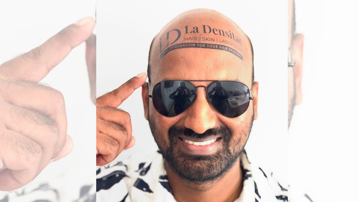 sahfeek hashim vlogs, 70mm vlogs, shafeek hashim densitae, baldness