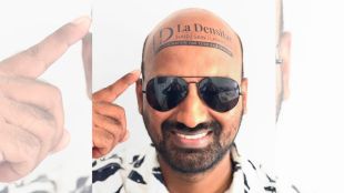 sahfeek hashim vlogs, 70mm vlogs, shafeek hashim densitae, baldness