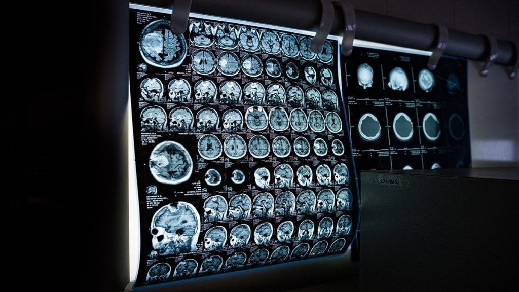 Your body fat may reveal your risk of Alzheimer’s disease