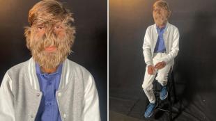 lalit patidar, werewolf syndrome, guinness world records, trending news, world record