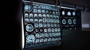 Parkinson's, Parkinson's disease, Parkinson's disease symptoms, Parkinson's treatment, Parkinson's law, Parkinson's disease stages, Parkinson's medication, Parkinson's dementia, Parkinson's disease cause, Parkinson's news, Parkinson's disease meaning, Parkinson's and dementia, Parkinson's association, Parkinson's and dopamine, Parkinson's awareness month, Parkinson's and constipation, Parkinson's age of onset, Parkinson's and alcohol, Parkinson's and sleep, Parkinson's and anxiety, Parkinson's and depression, about Parkinson's disease, a cure for Parkinson's disease, autoimmune disease Parkinson's, Parkinson's biomarker, Parkinson's breakthrough 2024, Parkinson's breakthrough 2025, Parkinson's Brett Favre, Parkinson's breakthrough, Parkinson's boxing, Parkinson's belt, Parkinson's belt map, Parkinson's brain surgery, Parkinson's big exercises, Brett Favre Parkinson's, Bob Costas Parkinson's, Brett Favre Parkinson's disease, blood test for Parkinson's, Bruce Springsteen Parkinson's, best pain medication for Parkinson's disease, best edibles for Parkinson's, Parkinson's charity, Parkinson's cause of death, Parkinson's clinical trials 2024, Parkinson's cure 2025, Parkinson's CBD trial, Parkinson's cure news, Parkinson's clinical trials, Parkinson's cure 2024, Parkinson's causes, Parkinson's cure, causes of Parkinson's disease, Christopher Meloni Parkinson's, can you die from Parkinson's disease, Chuck Todd Parkinson's disease, cure for Parkinson's disease, Parkinson's disease treatments, Parkinson's disease medication, Parkinson's disease Michael J. Fox, Parkinson's disease news, Parkinson's dopamine, does Parkinson's affect memory, diagnosis of Parkinson's disease, Dennis Quaid Parkinson's disease, define Parkinson's disease, DBS Parkinson's, Parkinson's early symptoms, Parkinson's exercises, Parkinson's exercises PDF, Parkinson's end-stage life expectancy, Parkinson's end stage, Parkinson's exercise program, Parkinson's eyes watering, Parkinson's exercise classes near me, Parkinson's early onset, Parkinson's exercise classes, early signs of Parkinson's, early onset Parkinson's, end stage Parkinson's, end stage Parkinson's sleeping all the time, effects of Parkinson's disease, end stage Parkinson's death, end stage Parkinson's swallowing, Parkinson's foundation, Parkinson's face, Parkinson's finger test, Parkinson's freezing, Parkinson's fatigue, Parkinson's first symptoms, Parkinson's foundation careers, Parkinson's freezing gait, Parkinson's foundation grants, Parkinson's fluctuations, first signs of Parkinson's, foods to avoid with Parkinson's disease, famous people with Parkinson's disease, final stages of Parkinson's, Favre Parkinson's, focused ultrasound for Parkinson's, finger test for Parkinson's, health news, wellness news,