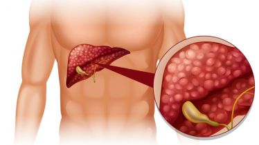 Signs of fatty liver