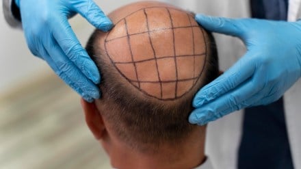 Two engineers die after alleged botched hair transplants at Kanpur clinic; Doctor on the run