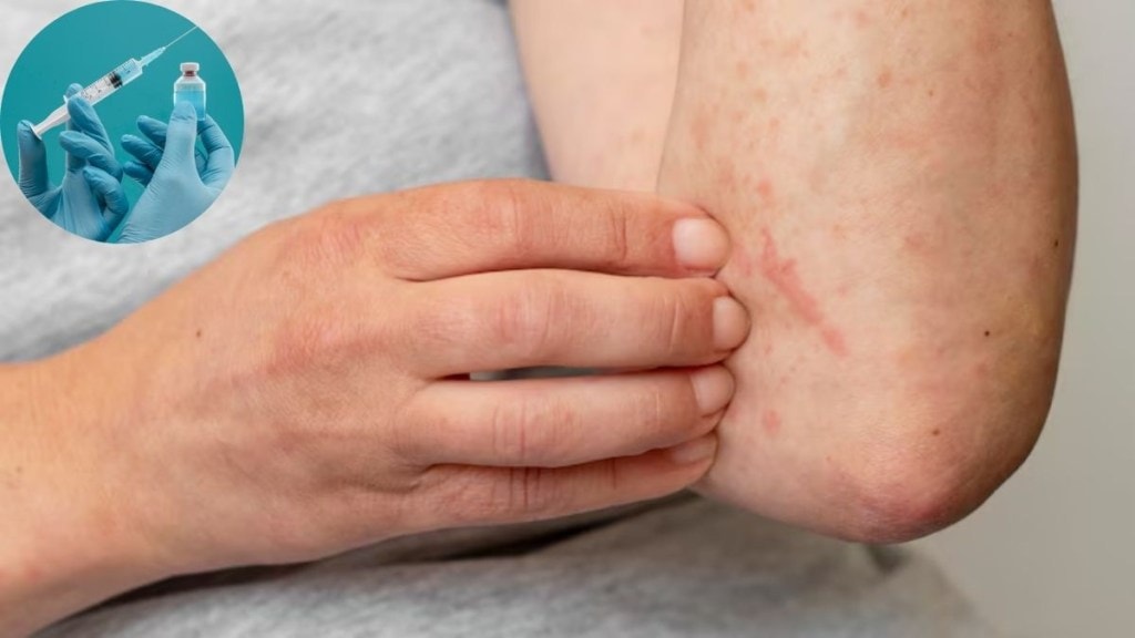 CDC travel advisory for measles
