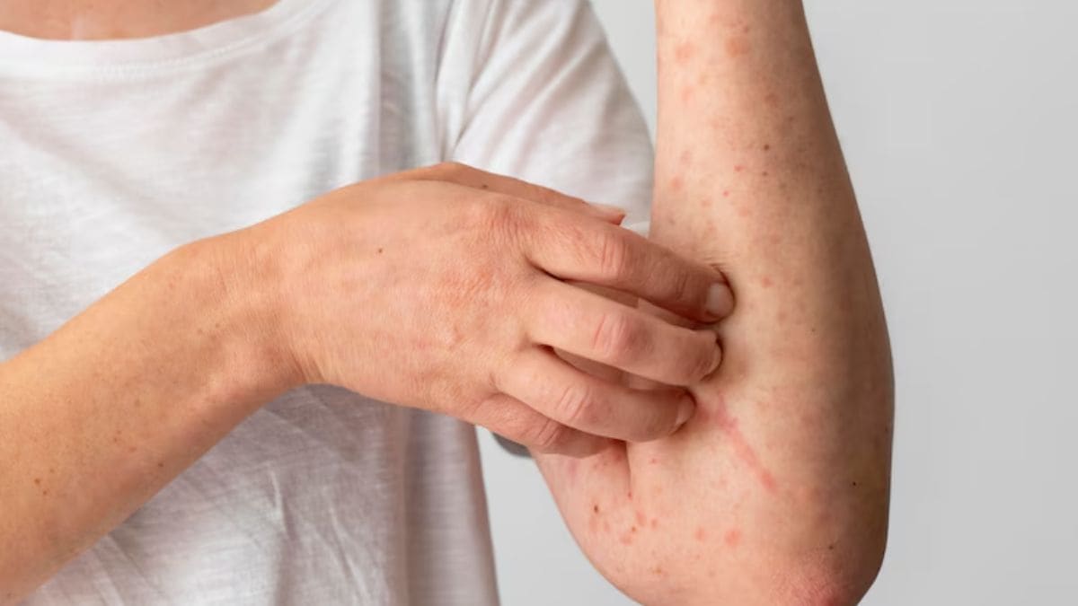 Measles outbreak Sydney