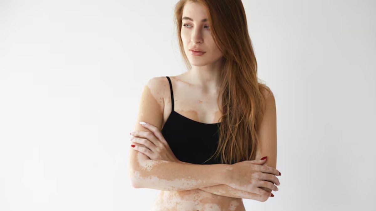 Emotional toll of vitiligo