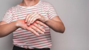 Fatty liver signs on hands