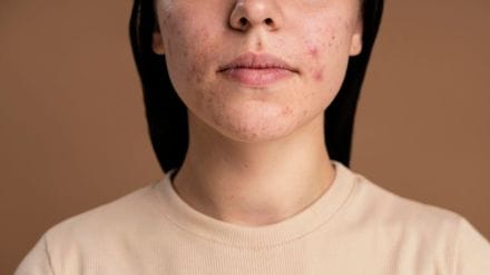 Fungal acne on rise