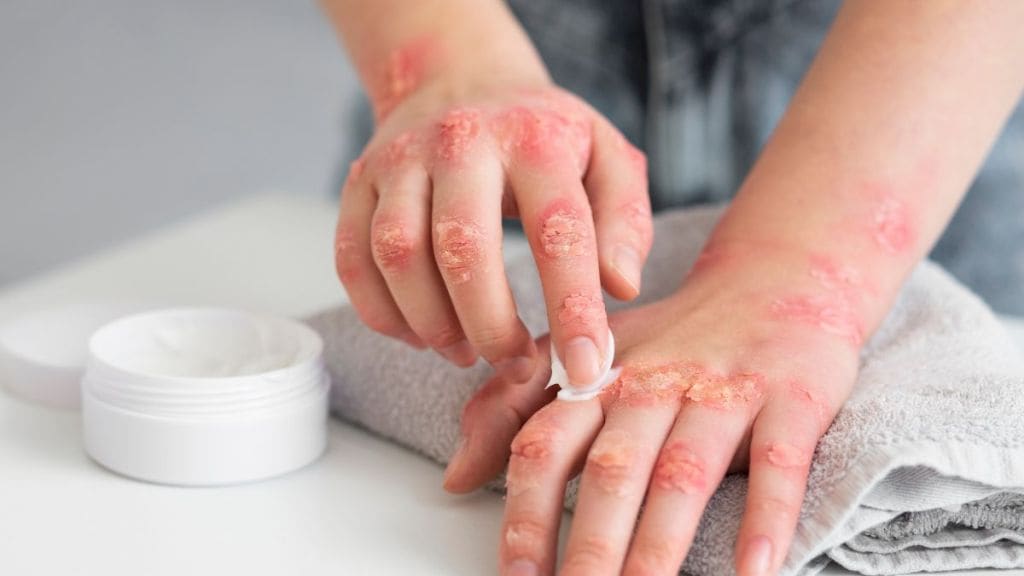32-year-old woman struggled with itchy skin