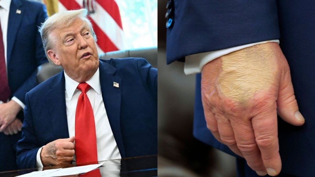 Trump hand bruise Trump hand bruise