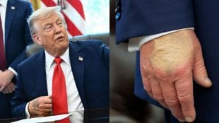 Trump hand bruise