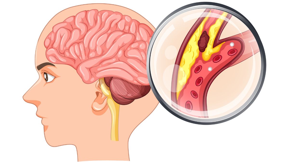 Naegleria fowleri, also referred to as brain-eating amoeba, can cause Primary Amebic Meningoencephalitis (PAM).
