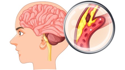 Naegleria fowleri, also referred to as brain-eating amoeba, can cause Primary Amebic Meningoencephalitis (PAM).