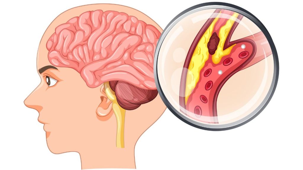Naegleria fowleri, also referred to as brain-eating amoeba, can cause Primary Amebic Meningoencephalitis (PAM). Naegleria fowleri, also referred to as brain-eating amoeba, can cause Primary Amebic Meningoencephalitis (PAM).