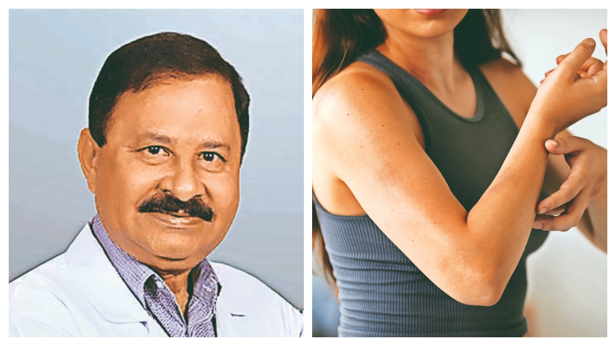 Dr DM Mahajan, senior consultant, dermatology, Indraprastha Apollo Hospitals (L)
