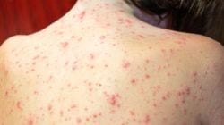 Chickenpox outbreak hits Kollam: Over 100 cases reported; How to spot symptoms, and keep yourself safe