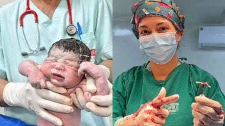 Baby born holding IUD in Brazil Baby born holding IUD in Brazil