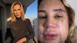 31-year-old instagram influencer dies after dangerous ‘fox eyes’ surgery