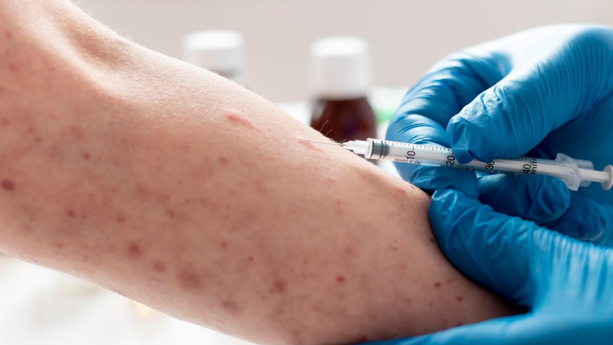 Mpox cases in California