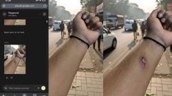 AI vs HR: Employee fakes medical injury using Google Nano Banana for paid leave, guess what happens next