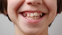 FDA restricts cavity-fighting fluoride drug sales for children; Here’s why it may be risky