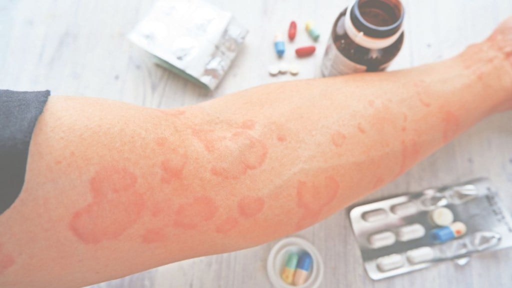 Cold urticaria happens when the skin reacts abnormally to cold, releasing chemicals like histamine, which cause hives, itching or swelling.