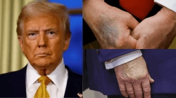 Is Trump’s health at risk? President reveals he takes a higher daily dose of aspirin. Here is why