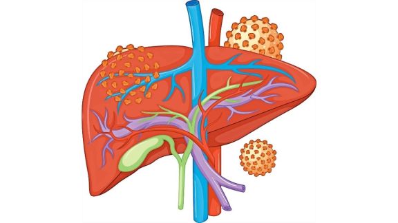 Why Hepatitis A Cases Are Rising in India and How to Stay Safe