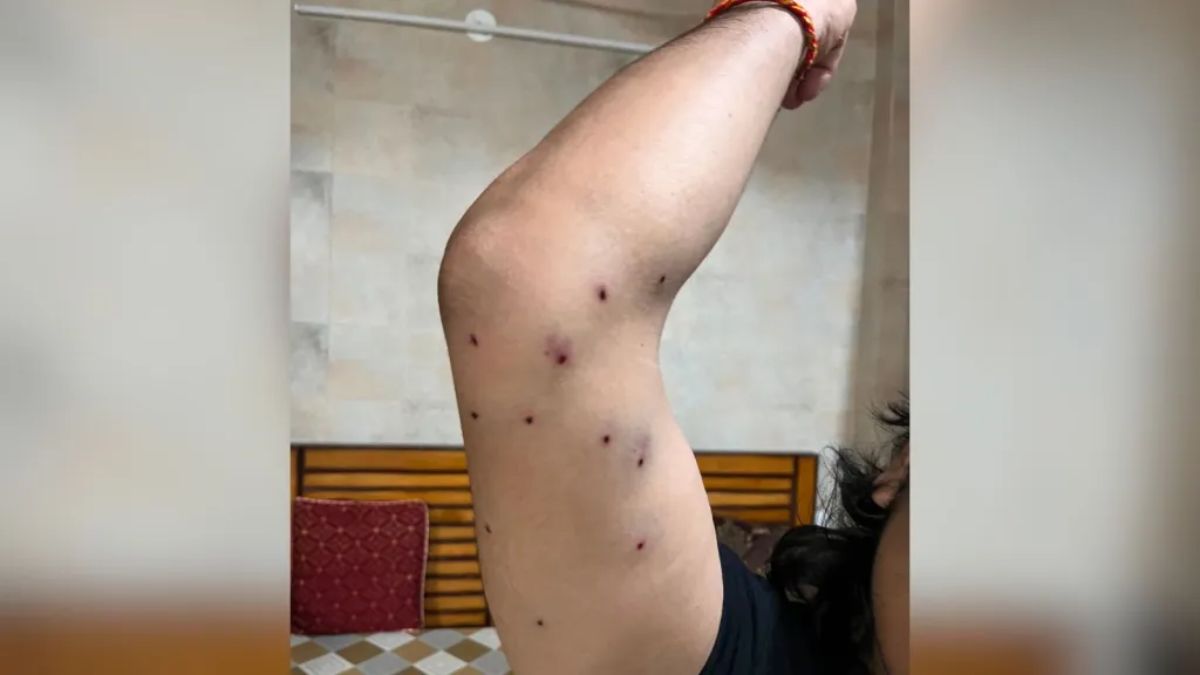 Doctors, however, advised against attempting to remove them. According to the journalist, they explained that extracting such a large number of pellets would require several incisions and could cause more damage than leaving them in place. Doctors, however, advised against attempting to remove them. According to the journalist, they explained that extracting such a large number of pellets would require several incisions and could cause more damage than leaving them in place.